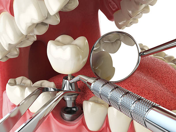 Best Broken or Chipped Tooth Repair in Doctor Phillips, FL